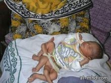 جراحة ناجحة لطفل باكستاني ولد بـ 6 أرجل