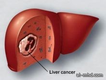 %11 من حالات سرطان الكبد ترتبط بالبدانة
