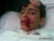 عسير: سقوط 5 أسنان و20 غرزة لطفل تعرض للاعتداء على أيدي إثيوبيين