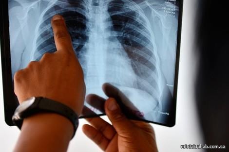 "الصحة": انخفاض معدل حالات مرض الدرن بنسبة 21% في المملكة عام 2022