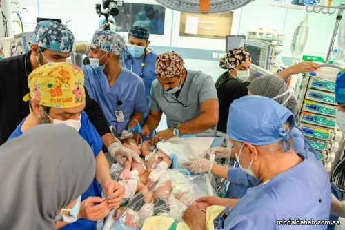 نجاح فصل التوأم السيامي العراقي "عمر وعلي" بعد عملية جراحية معقدة استغرقت 11 ساعة