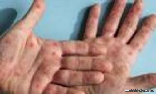 تأكيد أول إصابة بالسلالة 1 من جدري القرود في أمريكا